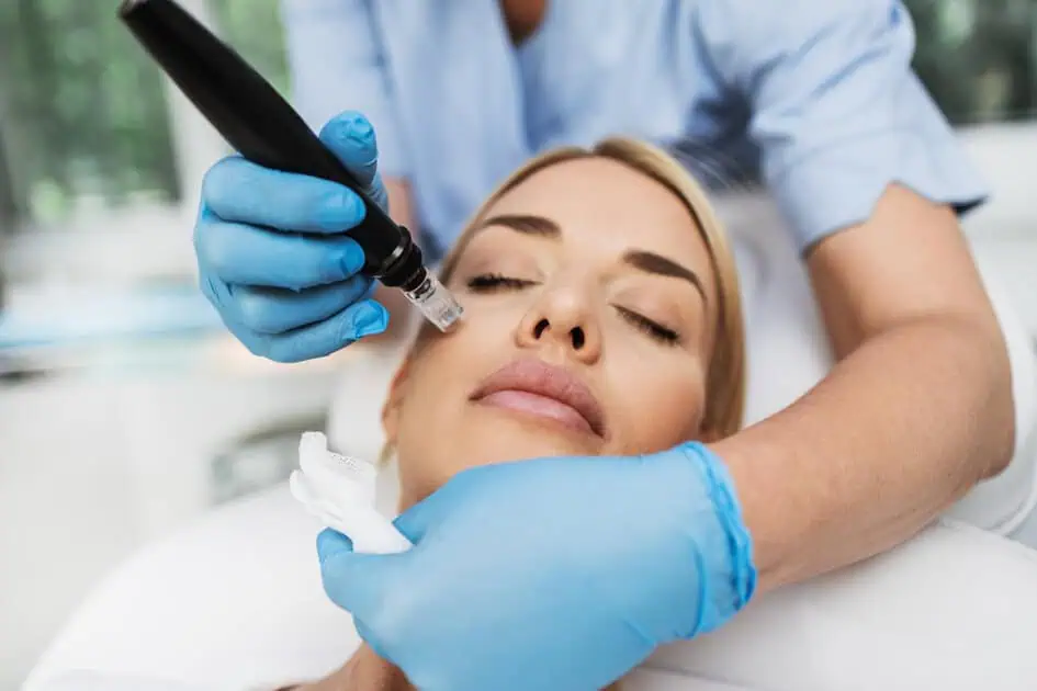 RF Microneedling treatment